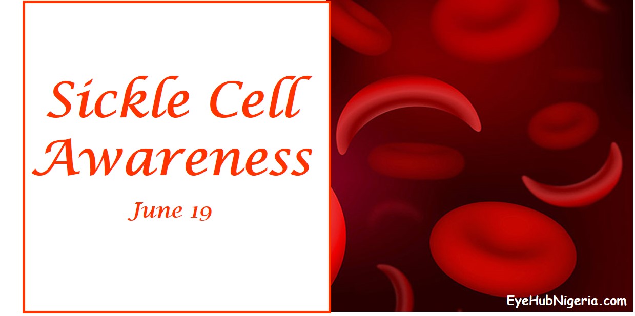 Spotlight on Sickle Cell - Sickle Cell Awareness Day || Eyehub Nigeria